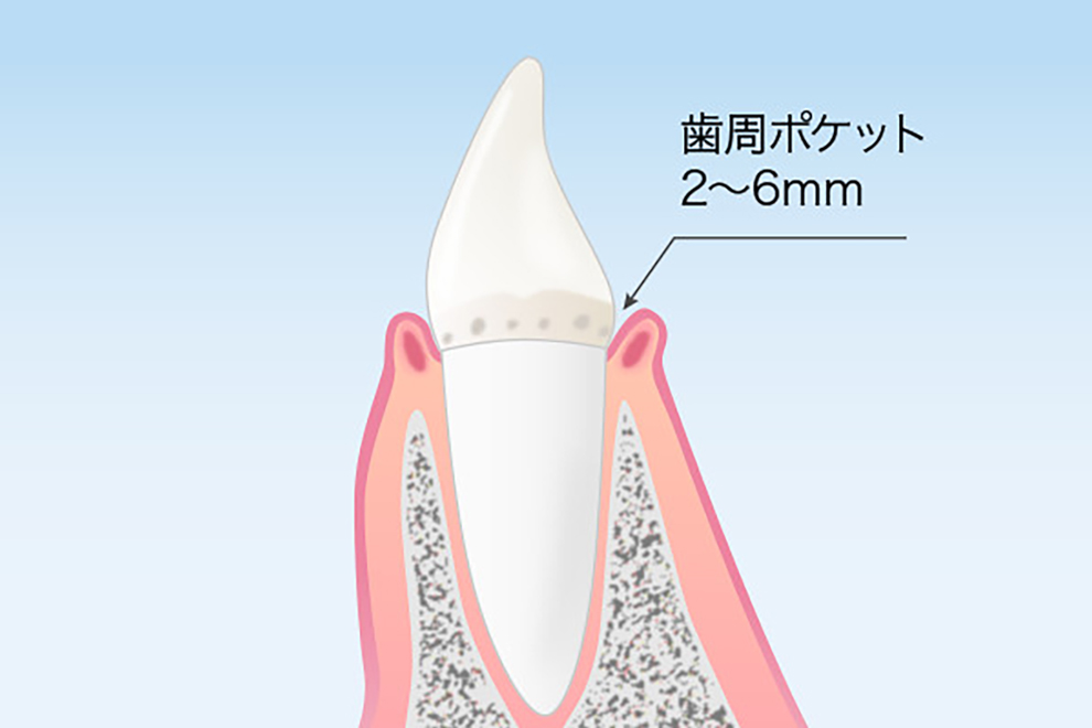新橋駅・AKuA Dental Clinic・歯肉炎