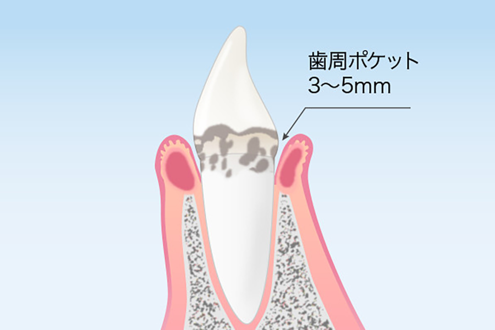 新橋駅・AKuA Dental Clinic・歯周炎（軽度）