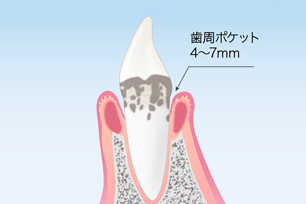新橋駅・AKuA Dental Clinic・歯周炎（中等度）