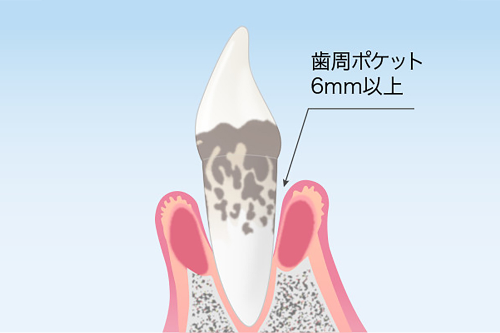 新橋駅・AKuA Dental Clinic・歯周炎（重度）